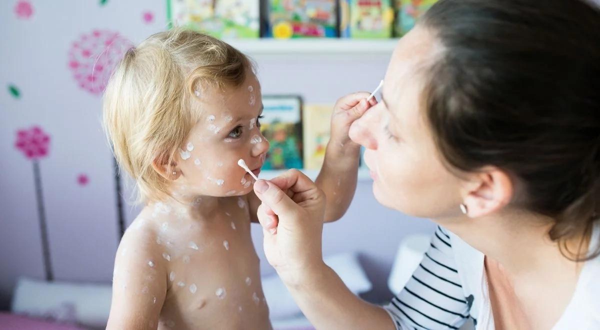 Ospa wietrzna w centrum pomocy dla uchodźców. Sanepid zadecydował o izolacji