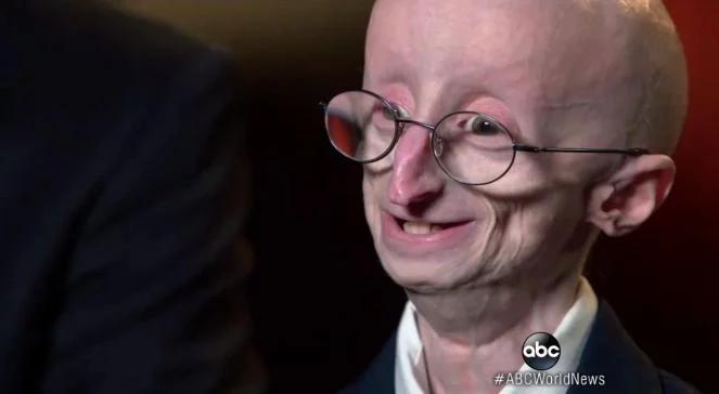 Sam Berns nie żyje. Najsłynniejsze dziecko chore na "przedwczesną starość"