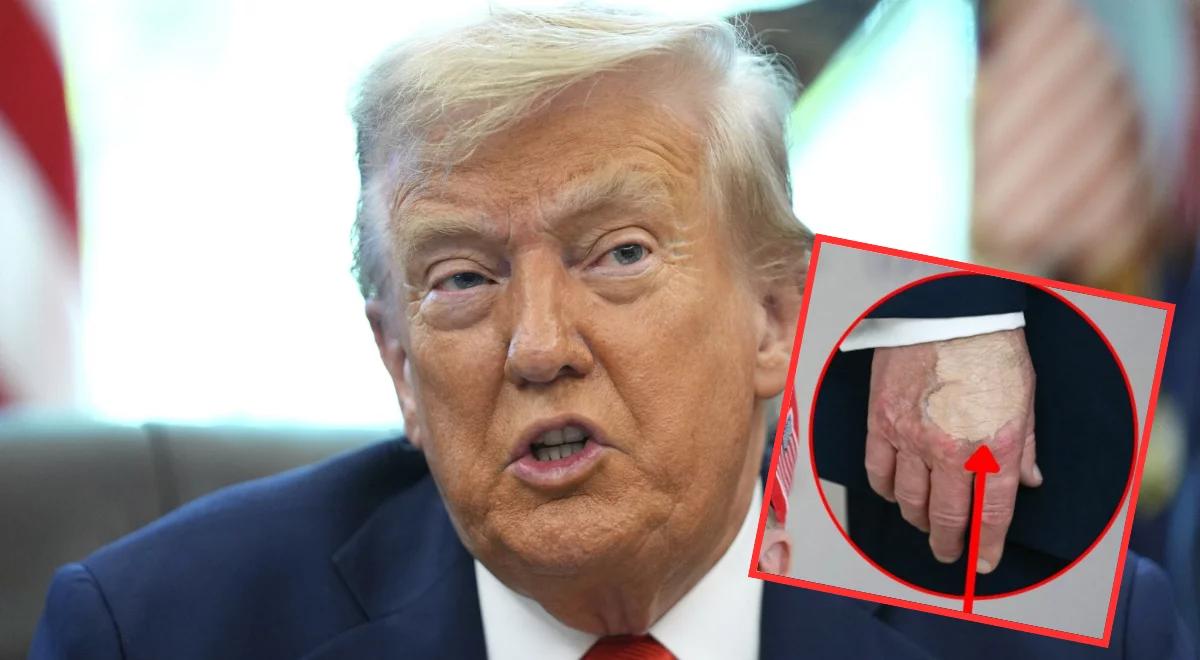 Tajemnicze siniaki na dłoni Donalda Trumpa. Biały Dom zabrał głos