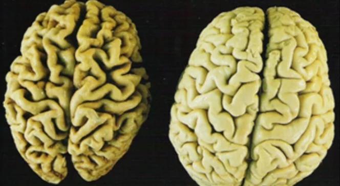 To może być przełom. Naturalne białko pomoże leczyć Alzheimera?