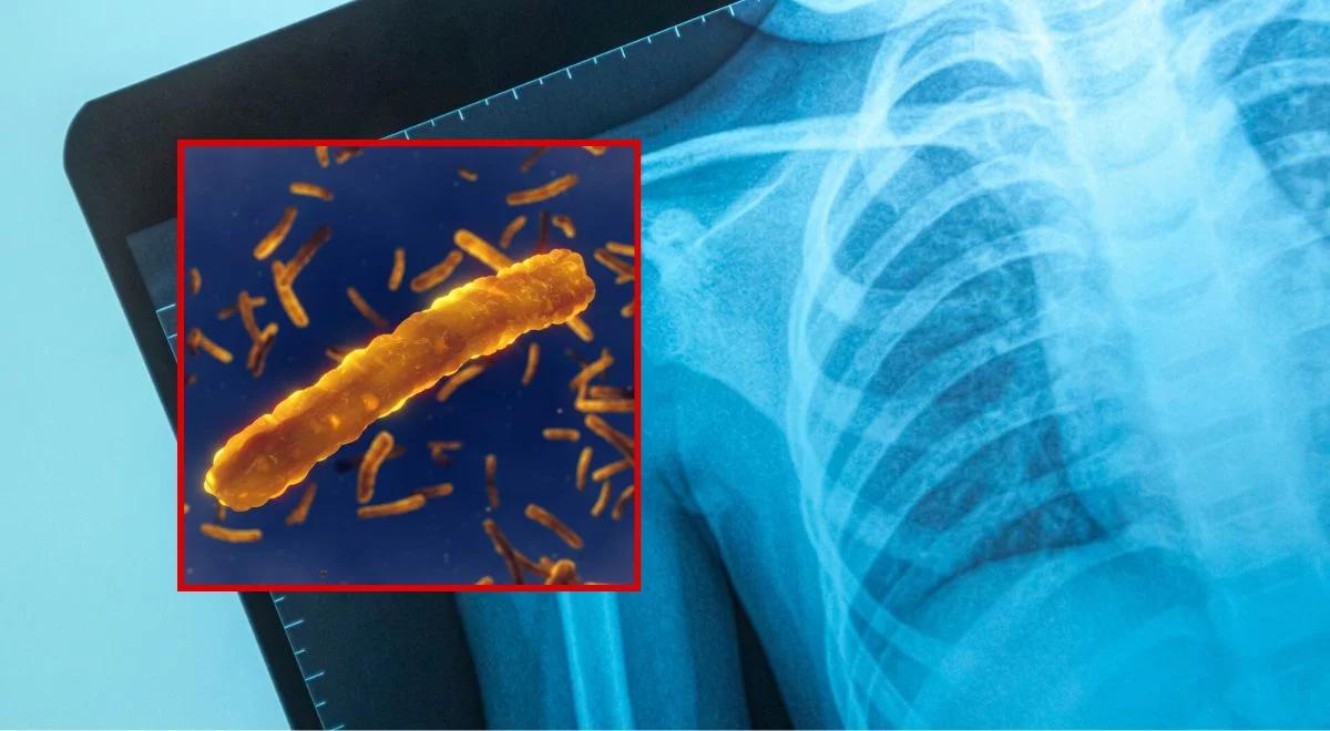 Gruźlica atakuje Europę. Rośnie liczba zakażeń wśród dzieci