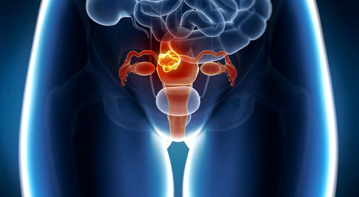 Mięśniak macicy – nowotwór bezobjawowy